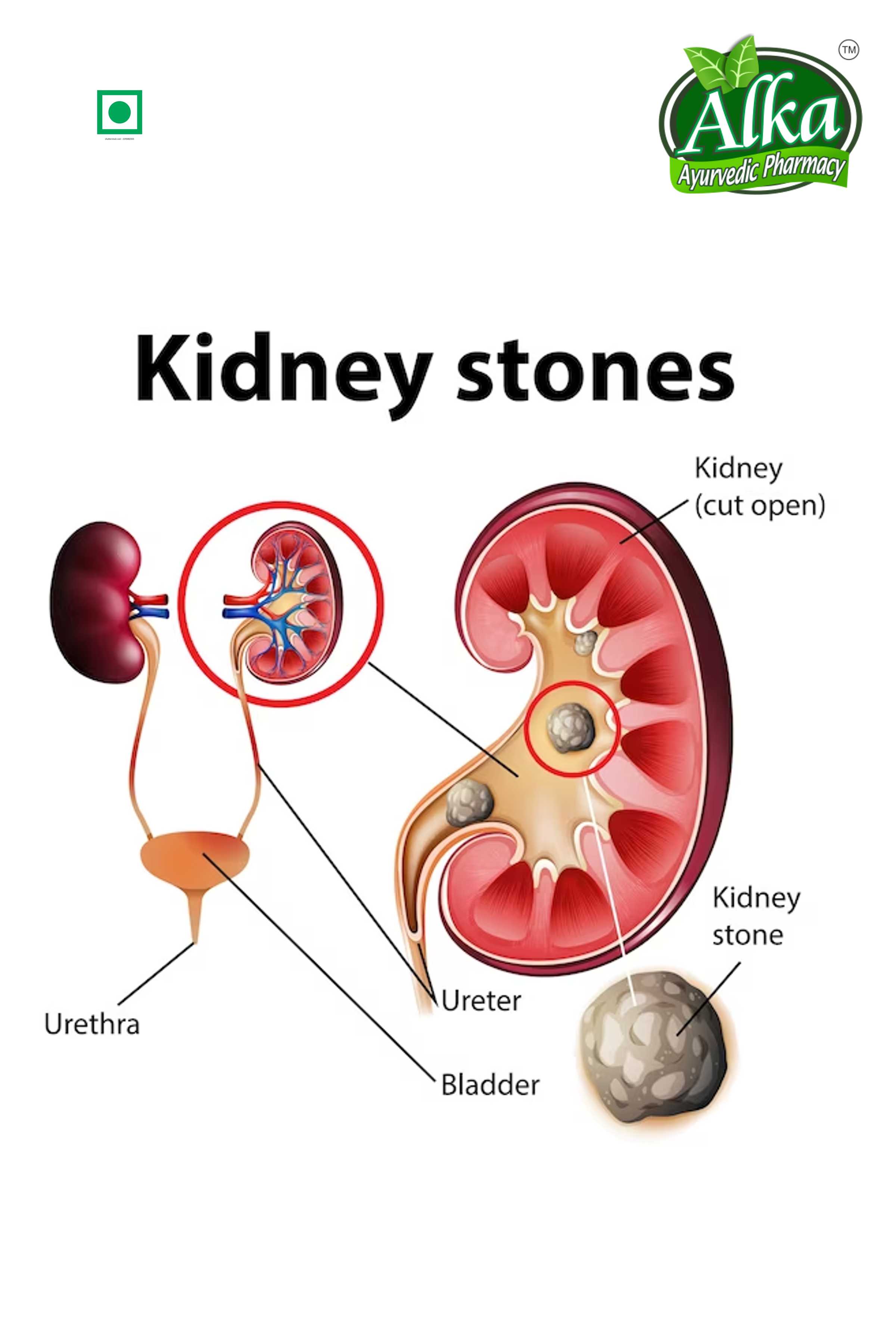 Kidney Stone Removal Powder (Stonix)